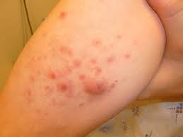 A similar lymphocyte called a natural killer (nk) cell shares many features with t cells. Lymphoma T Cell All Variants Dermatology Advisor
