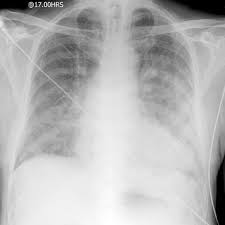 La embolia pulmonar suele ser causada por coágulos sanguíneos que viajan a los pulmones desde las piernas. Edema Polmonare Acuto Wikipedia