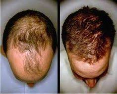 I have been told i have a diffuse hair thinning pattern of hair loss. Can You Have A Hair Transplant With Diffuse Hair Loss Hair Restoration News