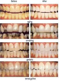 Image result for Tooth Discoloration