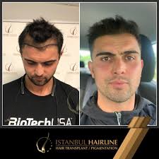 Ertem Sener Sac Ekiminde Mucize Istanbul Hairline Facebook
