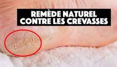 Remede Naturel Contre Les Crevasses Astuces De Grand Mere Remedes Naturels Huile Amande Douce Crevasse