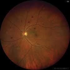 Find national data on vision and eye health. Reconsider Your Approach To Diabetic Retinopathy