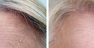 Cildin Pul Pul Dokulmesine Karsi Ev Yapimi Peeling Maskesi Pembe Dogal Cilt Bakimi Kuru Cilt Dogal Cilt
