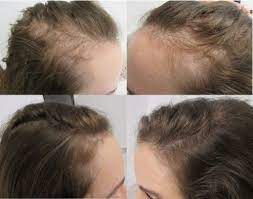 A collagen deficiency can be especially damaging to men and women who have started to see signs of hair loss. Hair Loss In Women Why It Happens And What You Can Do About It
