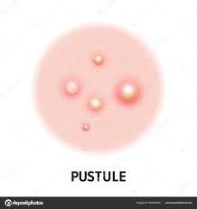 Image result for Pustule