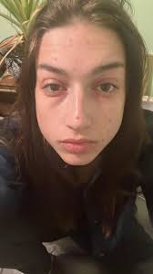 Help Please Oh acne why it so itchy . What are the prevention tips for  acne🥴😵‍💫 Is this part of aging ? I am 42 yrs old and I never experience  this