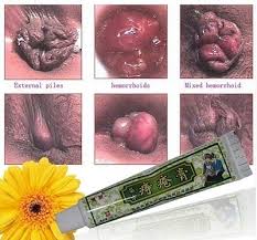 Caused by excess straining while passing stool, lifting heavy weights, and pregnancy, symptoms. Qoo10 Hemorrhoids External Hemorrhoids Mixed Hemorrhoids Treatment Cream No Cameras Record