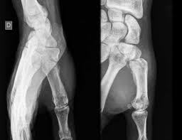 Dans le cas de l'arthrose des cervicales, la destruction touche les disques intervertébraux qui séparent chaque vertèbre. L Arthrose Post Traumatique Im2s