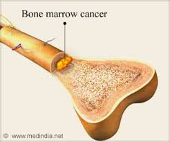 The tests can help diagnose if you are being treated for cancer, the results may show: Genetic Test May Help Pick Out Ultra High Risk Bone Marrow Cancer Patients