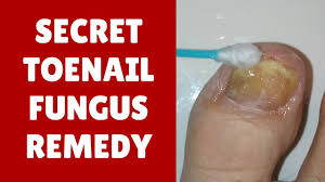 secret toenail fungus home remedy