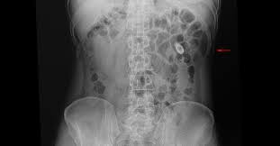 Show me pictures of kidney stones. Symptoms Of Kidney Stones Elite Medical Center
