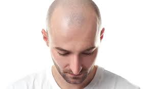 Male pattern baldness affects two-thirds of men but treatments