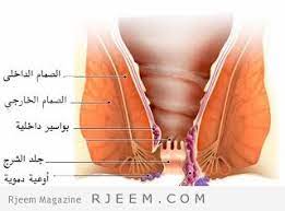 علاج بواسير المهبل وللحامل وبعد الولادة مجلة رجيم