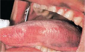 Leukoplakia of buccal mucosa removal by laser. Tongue Discoloration And Surface Changes Visual Diagnosis And Treatment In Pediatrics 3 Ed