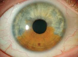 Image result for nevus sclerae