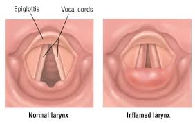 Image result for Acute Laryngitis