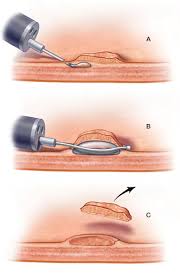 Endoscopic mucosal resection EMR
