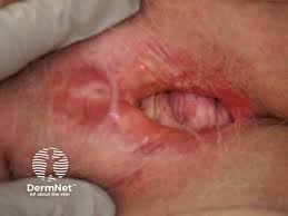 Image result for Labial Fusion