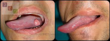 Image result for papillomavirus tongue)