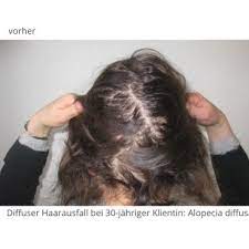 vorher nachher haarausfall frau category galerie vorher nachher frauen kaya veda ganzheitliche ayurveda methode in 2021 haarausfall frauen haarausfall haare