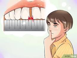 Fix gap in teeth close teeth gap without braces. How To Get Rid Of Gaps In Teeth 14 Steps With Pictures