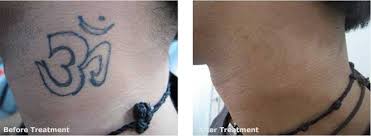 Does it hurt, how much it costs & other faqs. Blog Aura Skin Institute The World Of Dermatology Chandigarh India 2