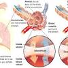 Some types of autoimmune diseases, such as rheumatoid arthritis, also can cause interstitial lung disease. Https Encrypted Tbn0 Gstatic Com Images Q Tbn And9gcsaqune32v9jpjnuyclj5lt6oxbsl G0alja715pu2rjug6e It Usqp Cau