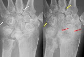 Image result for XRay Changes in Rheumatic Conditions