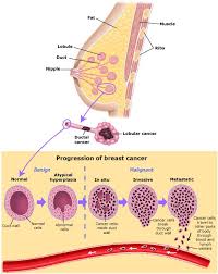 It also uses the mitotic rate, which is how fast their dividing. Types Of Breast Cancer Saint John S Cancer Institute