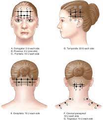 I was in an automobile wreck. Botox For Migraine Who Is It For What Does It Do What Does It Feel Like East Neurology