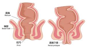 Image result for Rectal prolapse