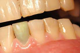 When your dentist detects the problem early on, they. Saving A Dead Tooth Healthguidance Org