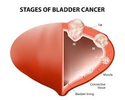 Cancer begins with a change (mutation) in the structure of the dna in cells, which can affect how they grow. 8 Symptoms Of Bladder Cancer You May Not Know The Healthy Lifestyle