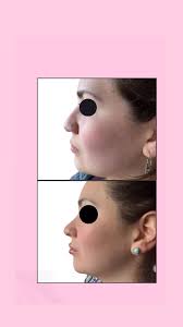 Rinolips 1 jeringa ácido hialuronico rinomodelación y 1 jeringa ácido en  labios. #acidohialuronico #estetica #rinomodelacion #labios