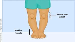 Bow Legs (Genu Varum) (For Parents) - Nemours Kidshealth