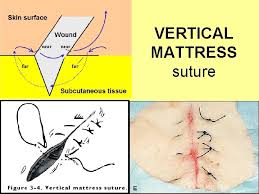 We did not find results for: Suturing Basics Topics Sutures Knots Wounds Classification Healing