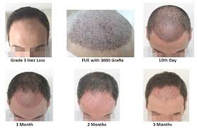 Native hair was thickened, and survival of implanted grafts were improved to achieve higher density, while progressive. Growth Of Hair After Fue Maral Hair