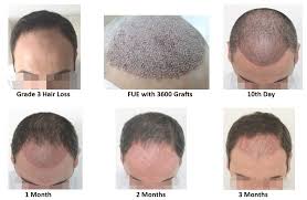 So 3 to 5 centimeters in just seven days sounds too good to be true, right? Growth Of Hair After Fue Maral Hair