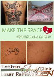 Homies unidos offers free tattoo removal for graduates of our epiphany project. Blackpool Laser Tattoo Removal Inkden Clinic Laser Tattoo Removal Tattoo Removal Laser Clinics