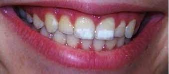 What Are White Spots On Teeth Ballantyne Family Dental