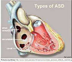 Biasanya akan terlihat jelas pada saat bayi menangis. Dr Beni Rusani On Twitter Jantung Berlubang Hole In The Heart Asd May Lead To Overflow Of Blood From Left To Right Side Of The Heart Causing Increase Pressure Enlargement Of Right