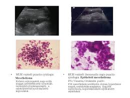 A legtöbb rosszindulatú pleurális folyadék a pleura áttétjeinek eredménye más oldalakról. Az Azbeszt Es A Legzoszervi Daganatok Fogyas Mesothelioma