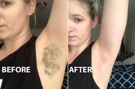 How to remove deodorant from armpits. Before You Switch To Natural Deodorant Try An Armpit Detox