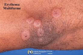 Image result for Erythema Multiforme