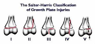 Image result for Growth Plate