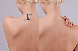 Because of the number of variables with how tattoos are. Some Important Things To Know About Laser Tattoo Removal Okc Oklahoma City Edmond Ok Mariposa Aesthetics Laser Center