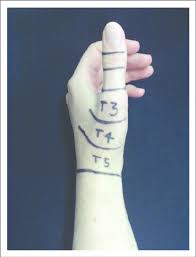 Maybe you would like to learn more about one of these? Thumb Extensor Pollicis Longus Zones Of Repair Included In Trial Download Scientific Diagram