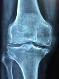 HD Wallpaper: X-ray Results On Bone, Knee, Old, Care, Injury, Pain, Knee  Pain | Wallpaper Flare