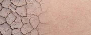 Trockene Haut Ursachen Tipps Pflege Mit Linolsaure